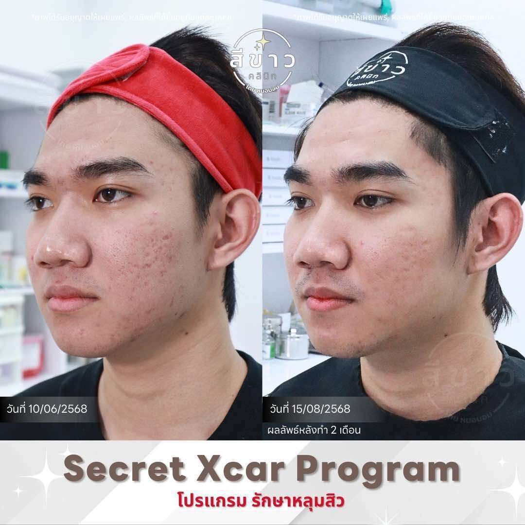 Secret Xcar Program - รักษาหลุมสิว เคส 1