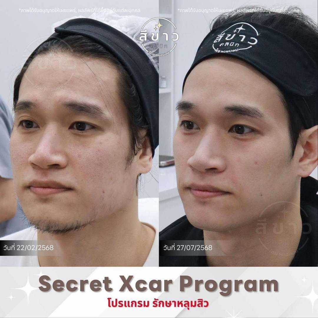 Secret Xcar Program - รักษาหลุมสิว เคส 2