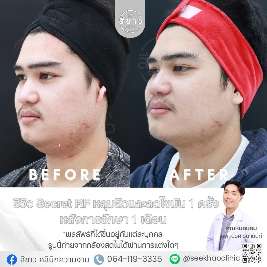 Secret RF หลุมสิวและลดไขมัน เคส 3