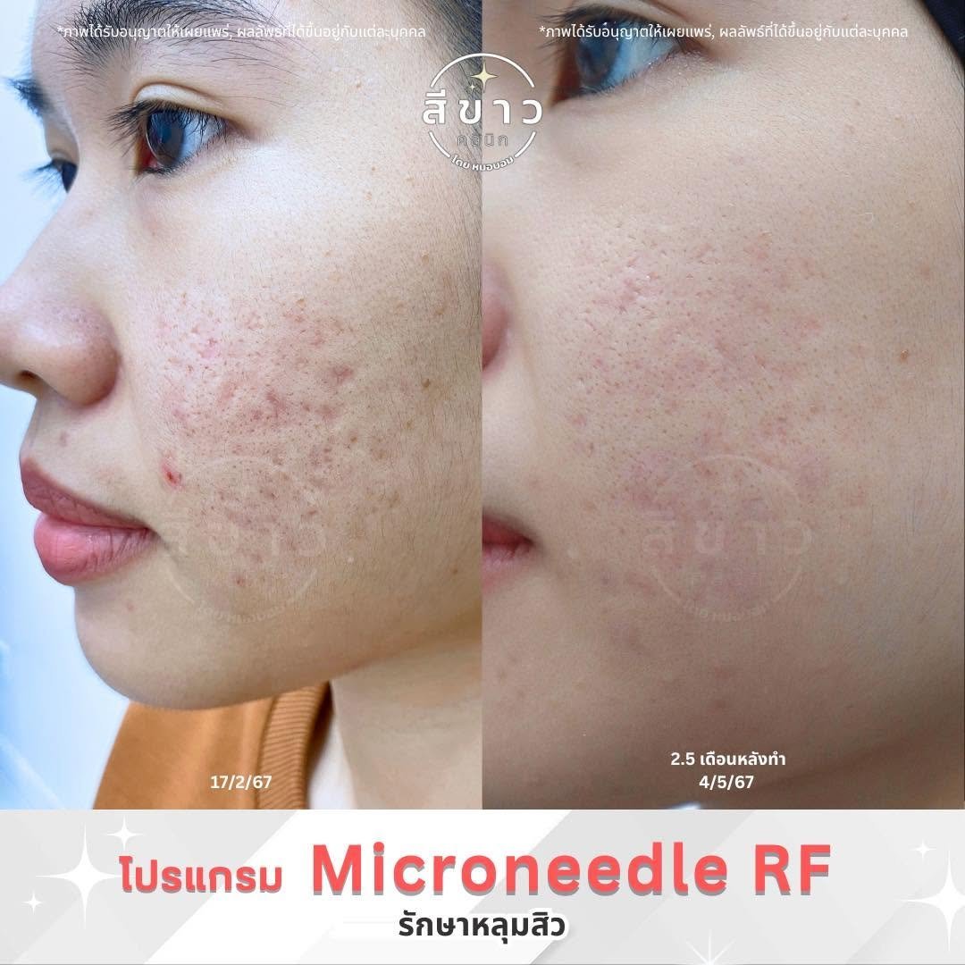 Microneedle RF รักษาหลุมสิว เคส 4