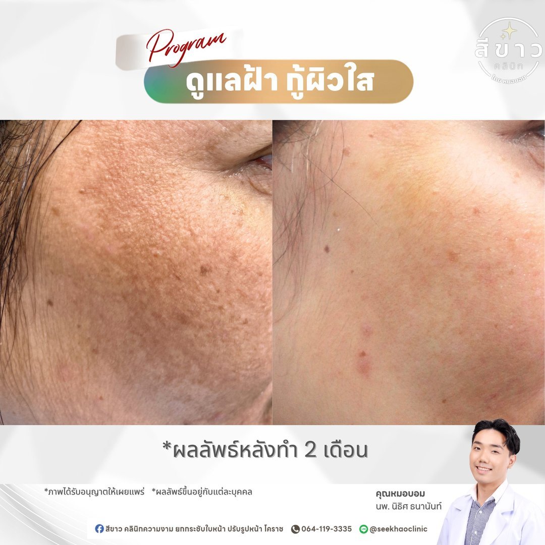 ดูแลฝ้า กู้ผิวใส