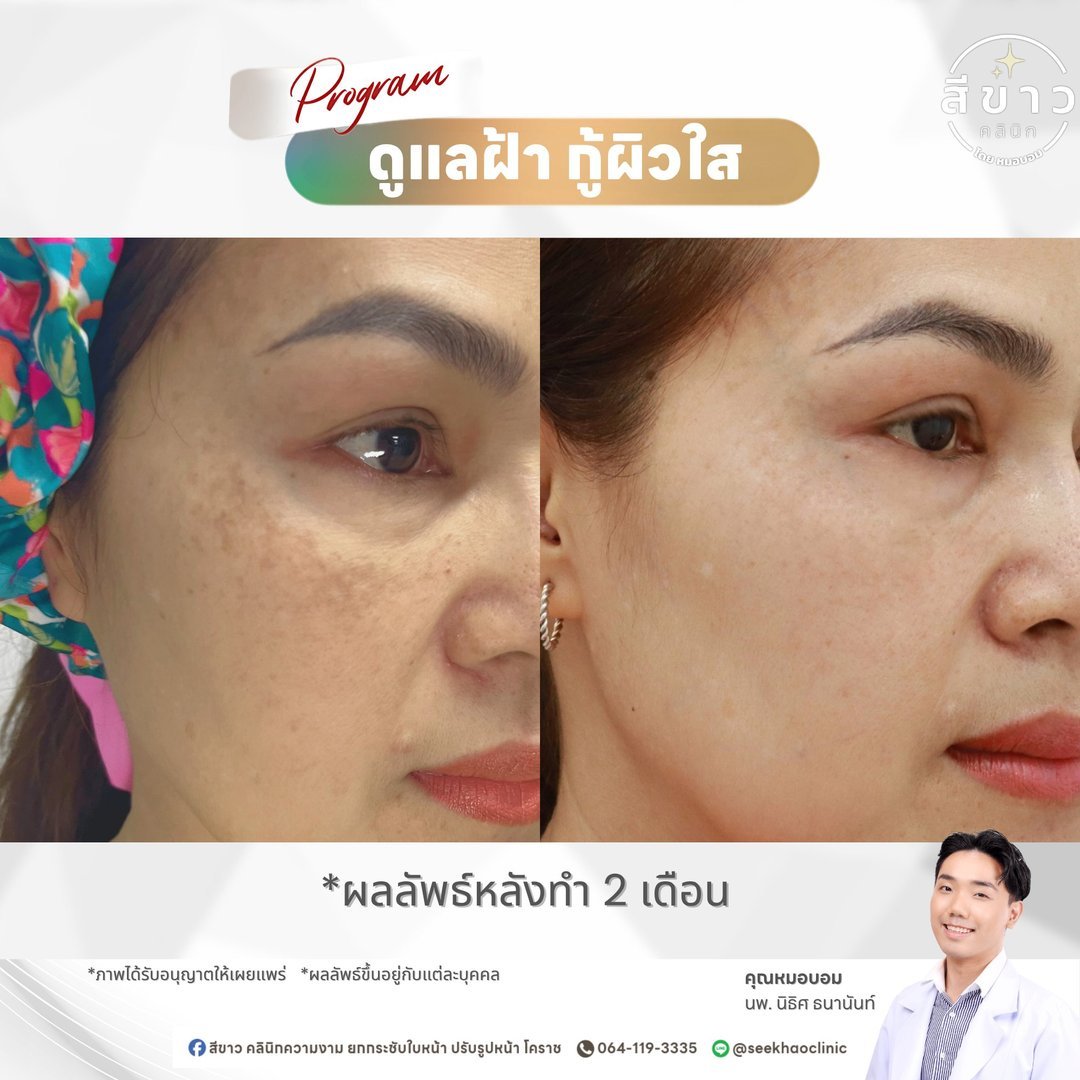 ดูแลฝ้า กู้ผิวใส