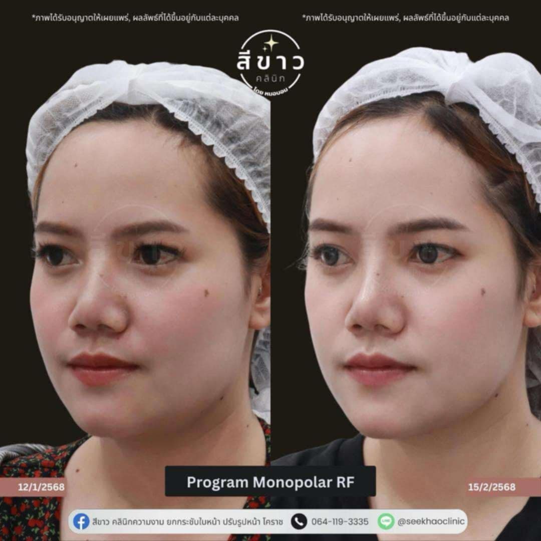 Monopolar RF