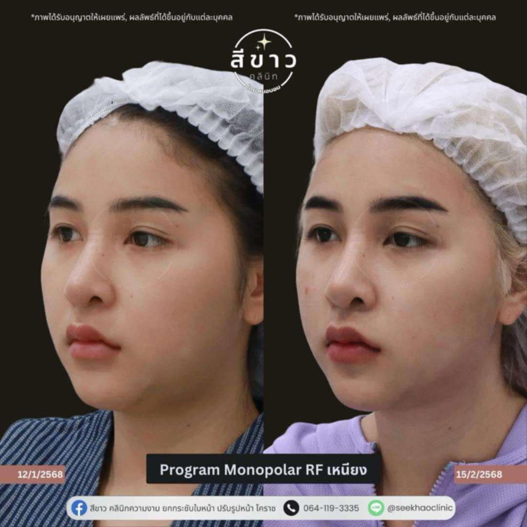 Monopolar RF เหนียง