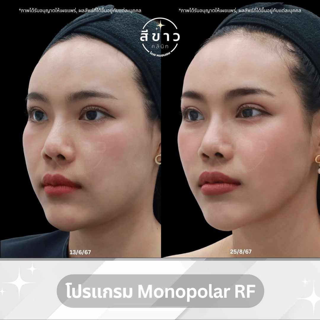 โปรแกรม Monopolar RF
